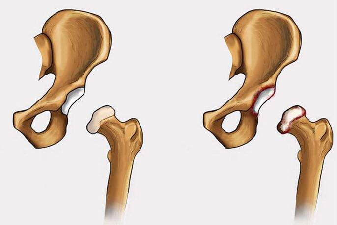 degeneratieve veranderingen en pijn in het heupgewricht