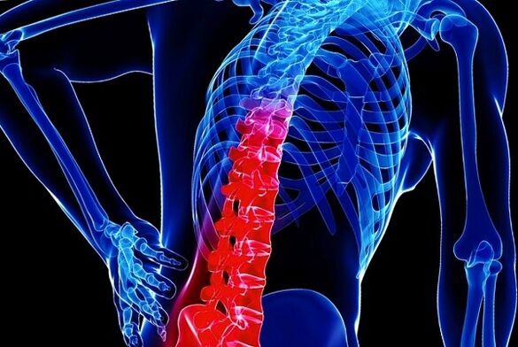 De redenen voor de ontwikkeling van thoracale osteochondrose
