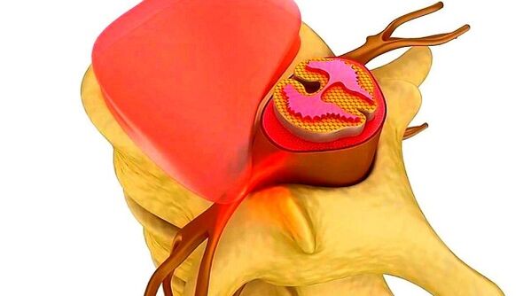 osteochondrose van de thoracale wervelkolom de essentie van de ziekte
