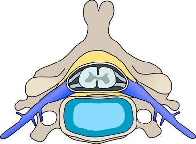 Protabius in de wervel met cervicale osteochondrose